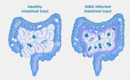 Small Intestinal Bacterial Overgrowth (SIBO) A Comprehensive Guide