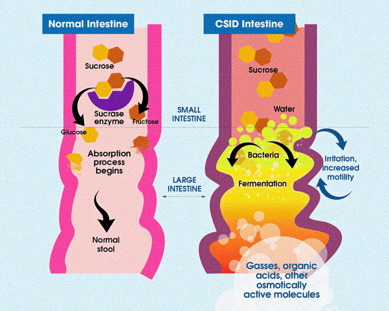 CSID Diet for Congenital Sucrase Isomaltase Deficiency - The Digestion ...